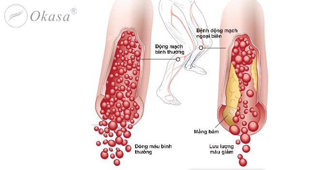 11 nguyên nhân gây ra chứng tê chân và phương pháp điều trị