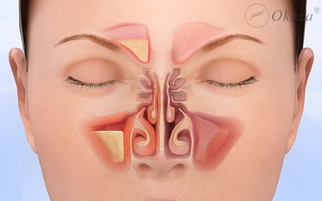 2 huyệt giúp giảm đau đầu vùng xoang và thông mũi