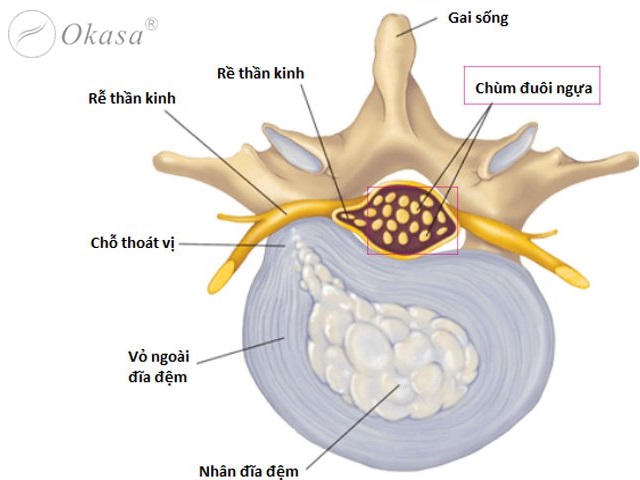 7 biến chứng của bệnh thoát vị đĩa đệm