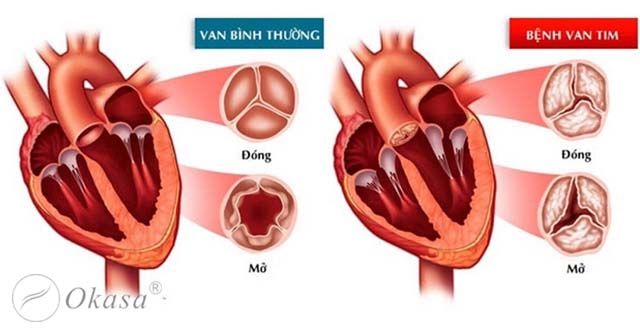 Ăn kiêng gì khi bị bệnh hở van tim?