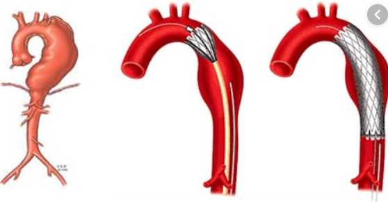 Đau bụng bên trái dưới xương sườn do phình động mạch chủ