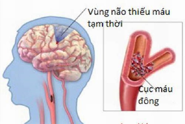 Đau đầu chóng mặt do tụt huyết áp