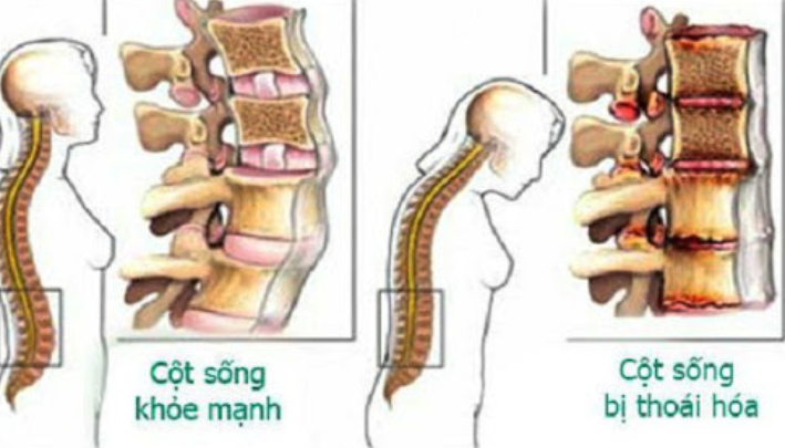 Đau dây thần kinh liên sườn phải làm sao