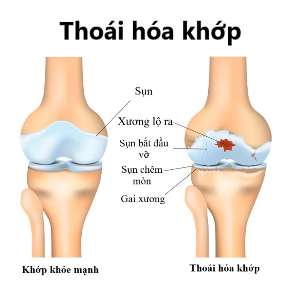 đau nhức xương khớp ở người trẻ do đâu