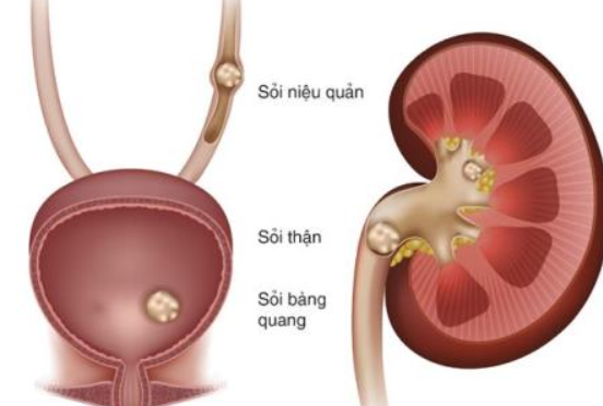 Đau sườn trái dưới tim do sỏi thận hoặc nhiễm trùng thận
