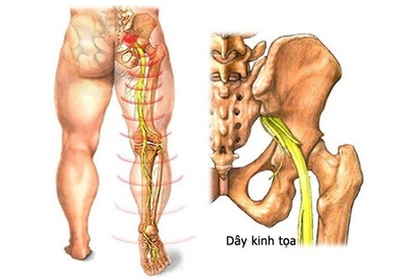 đau từ thắt lưng xuống chân phải là dấu hiệu của bệnh gì