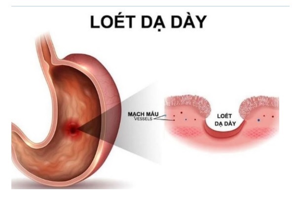 đau vùng thượng vị lan ra sau lưng do loét dạ dày