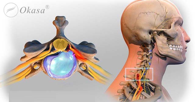 Bài tập hỗ trợ điều trị thoát vị đĩa đệm cổ