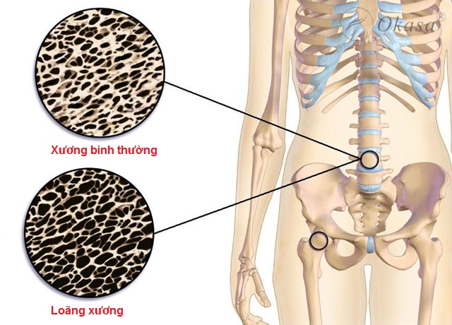 Bật mí 5 cách tốt nhất đối phó với chứng loãng xương