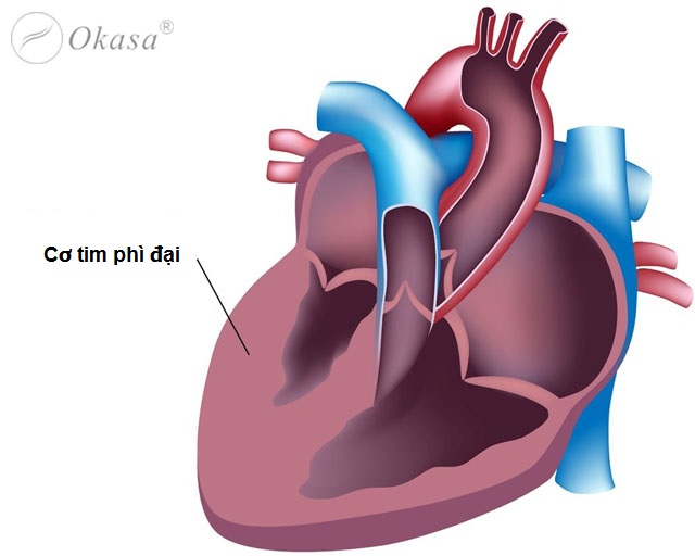 Bệnh cơ tim phì đại: Phân loại và Biến chứng
