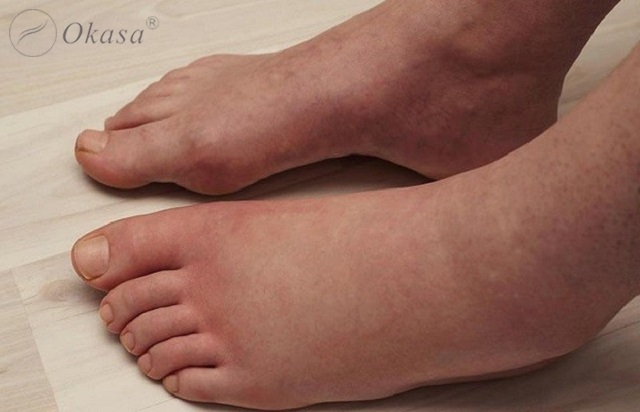 Bệnh phù chân ở người già