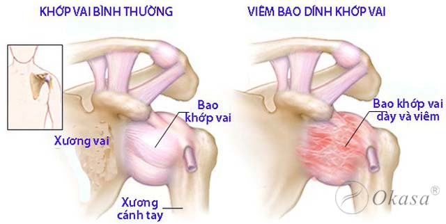 Bệnh viêm dính khớp vai: Nguyên nhân và phương pháp điều trị