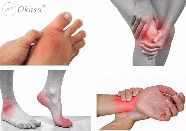 Bệnh viêm xương khớp gây biến chứng nguy hiểm