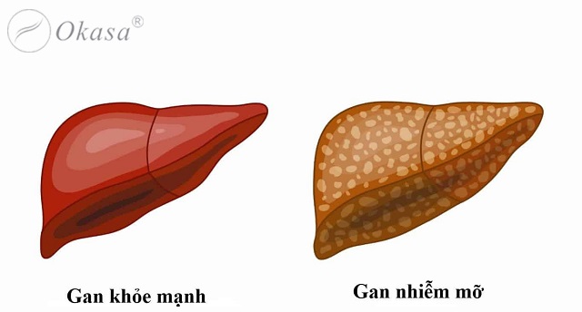 Béo phì có thể gây bệnh gan nhiễm mỡ