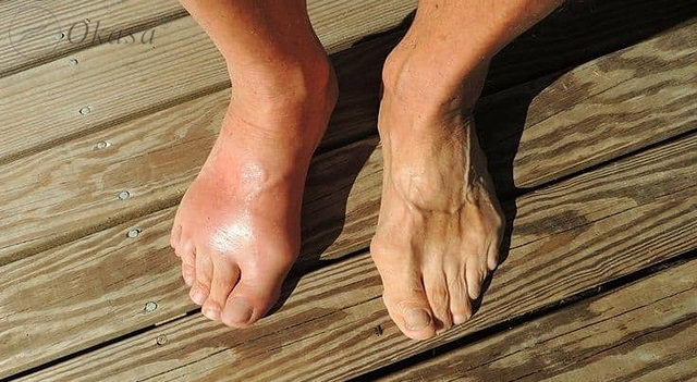 Béo phì có thể gây tổn hại tới hệ xương khớp