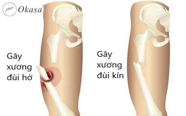 Bị nhiễm trùng sau gãy xương và phương pháp điều trị