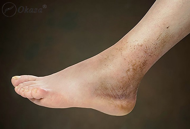 Bị nhiễm trùng sau gãy xương và phương pháp điều trị