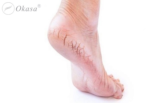 Bí quyết chăm sóc cho đôi chân của bạn