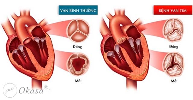 Các bệnh lý thường xảy ra ở van tim