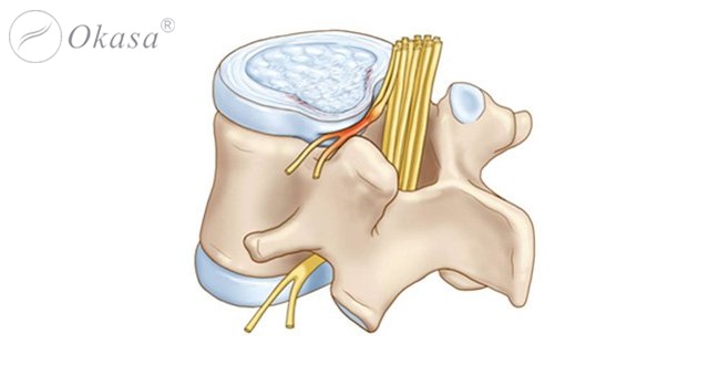 Các chứng đau cột sống và nguyên nhân