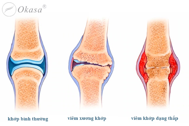 Các tính chất đặc trưng của bệnh viêm khớp dạng thấp