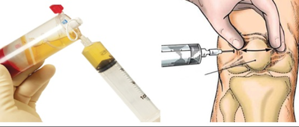 cách chữa bệnh đau khớp gối ở người già