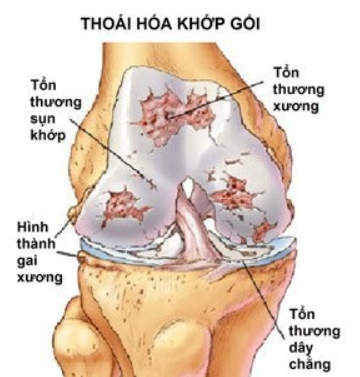 cách chữa đau khớp gối ở người già hiệu quả