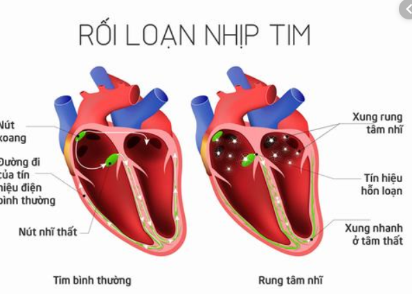 cách chữa rối loạn thần kinh thực vật bằng đông y