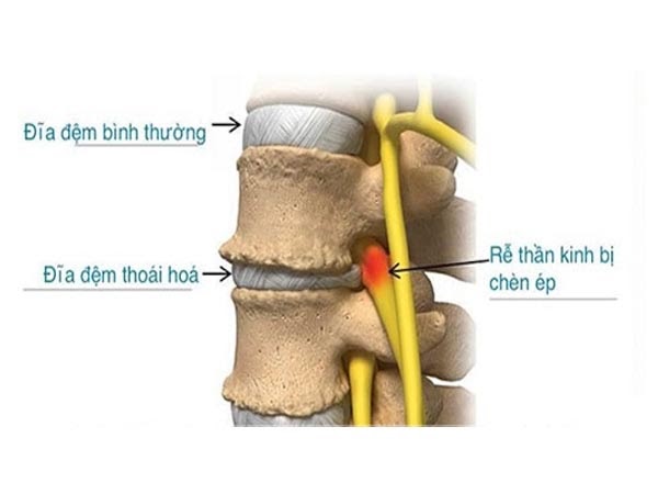 cách chữa thoát vị đĩa đệm cột sống thắt lưng hiệu quả