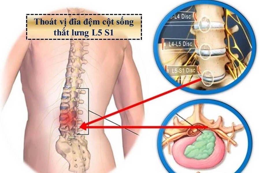 cách chữa thoát vị đĩa đệm cột sống thắt lưng tại nhà