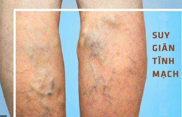 cách điều trị đau nhức khớp tay chân