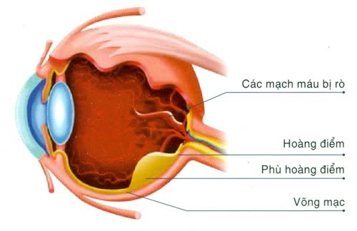 cách khắc phục đau nửa đầu bên phải và nhức mắt