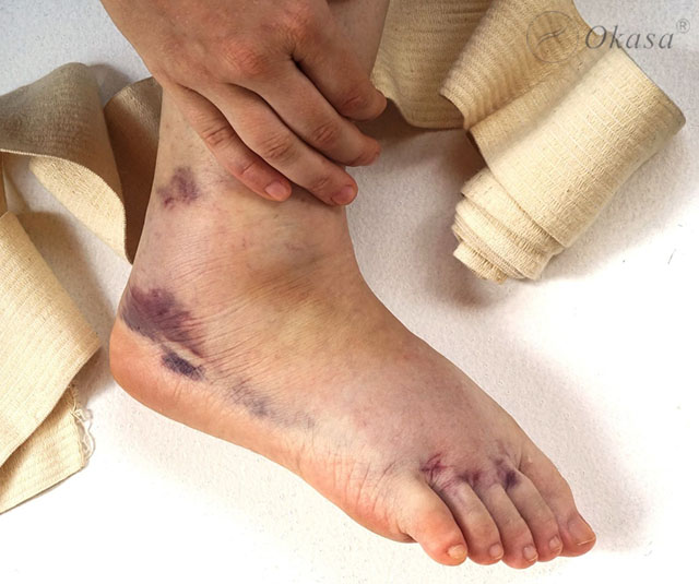 Cách massage bấm huyệt cho người bong gân