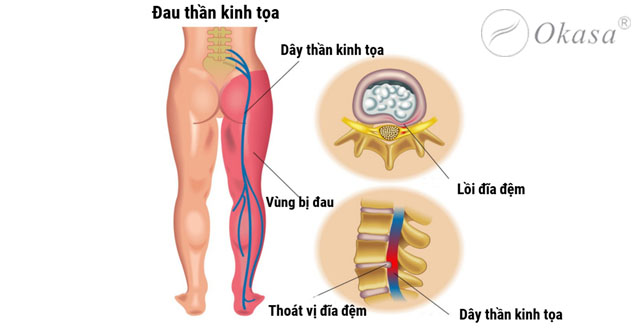 Cách massage bấm huyệt trị đau thần kinh tọa