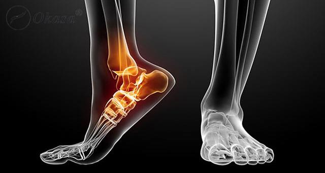 Cách xử lý khi bị trật khớp cổ chân