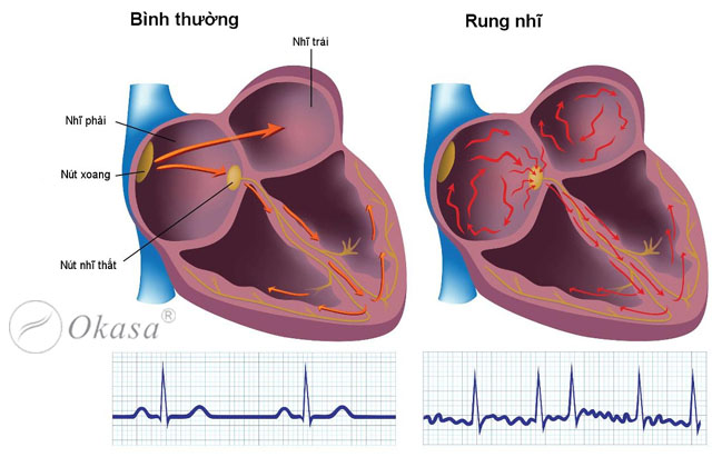 Cấu tạo của tim và tình trạng rung nhĩ