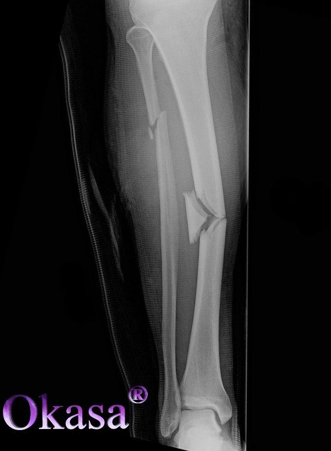 chăm sóc hồi phục sau gãy xương