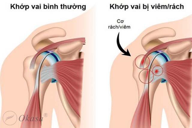 Chẩn đoán bệnh viêm cơ vai
