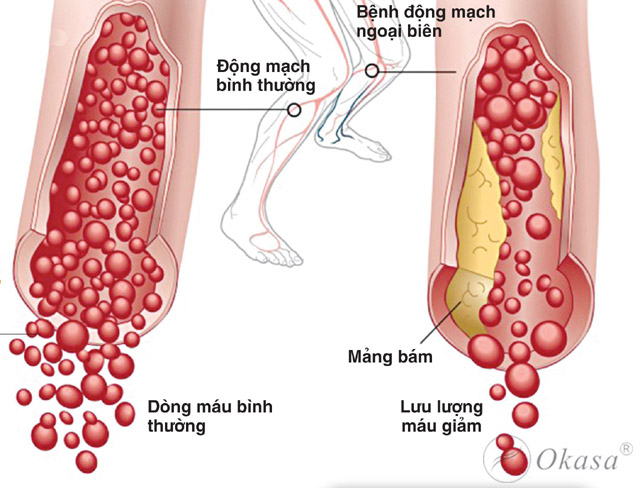 Chẩn đoán và điều trị bệnh động mạch biên chi dưới