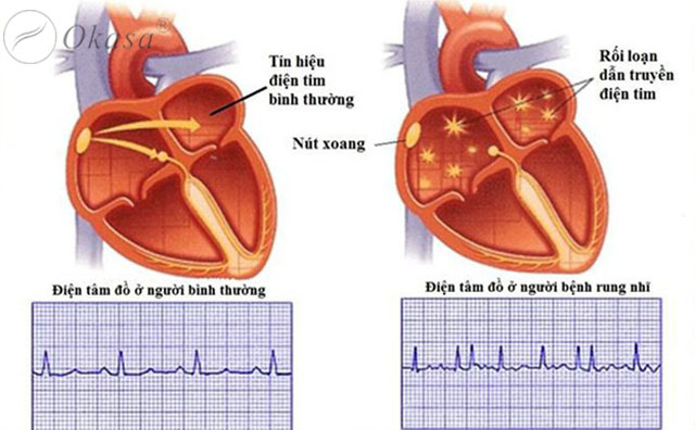 Chẩn đoán và triệu chứng bệnh rung nhĩ