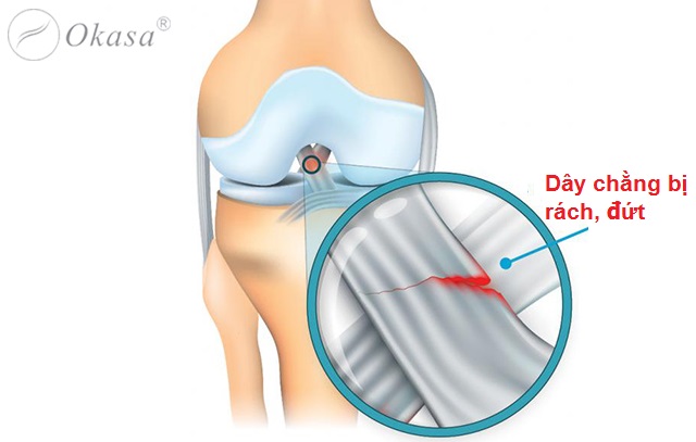 Chấn thương thường gặp khi thể dục thể thao
