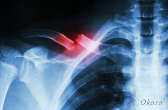 Chấn thương xương quai xanh và phương pháp điều trị