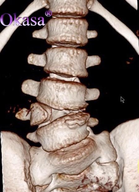cong vẹo cột sống bẩm sinh