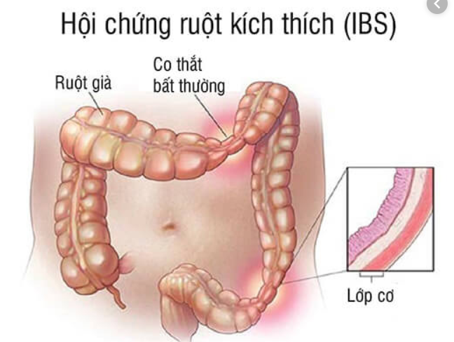 đau bụng quặn từng cơn vùng xung quanh rốn do kích thích ruột