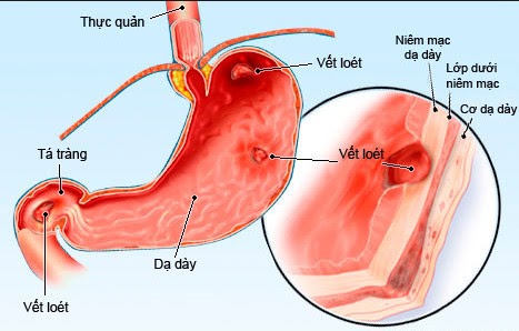 đau bụng quanh rốn từng cơn do bệnh lý về dạ dày