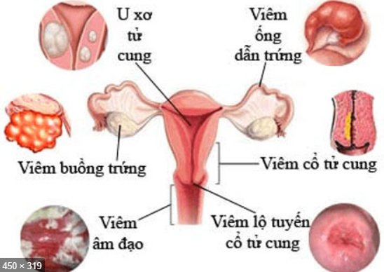 đau bụng quanh rốn từng cơn do bệnh phụ khoa