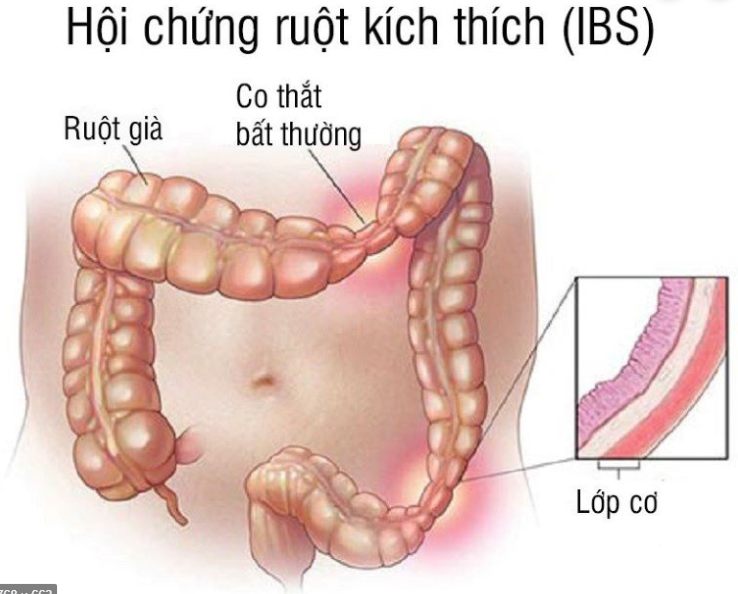 đau bụng quanh rốn từng cơn do hội chứng ruột kích thích