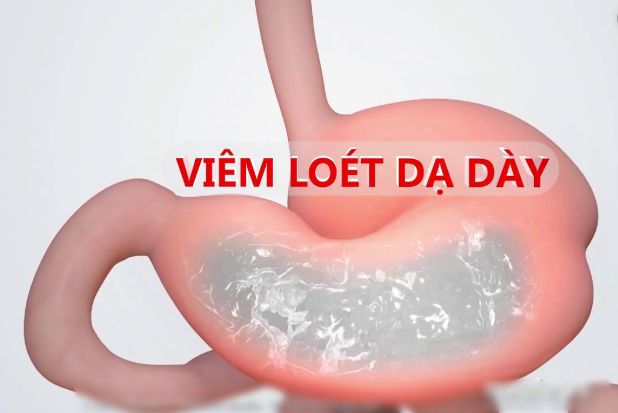 đau bụng quanh rốn từng cơn do viêm đường tiêu hóa