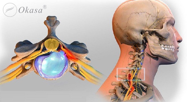 Đau đầu sau gáy cảnh báo của một số bệnh lý