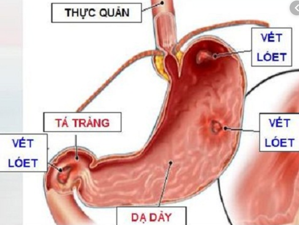 Đau dây thần kinh liên sườn có thể gây ra bệnh gì